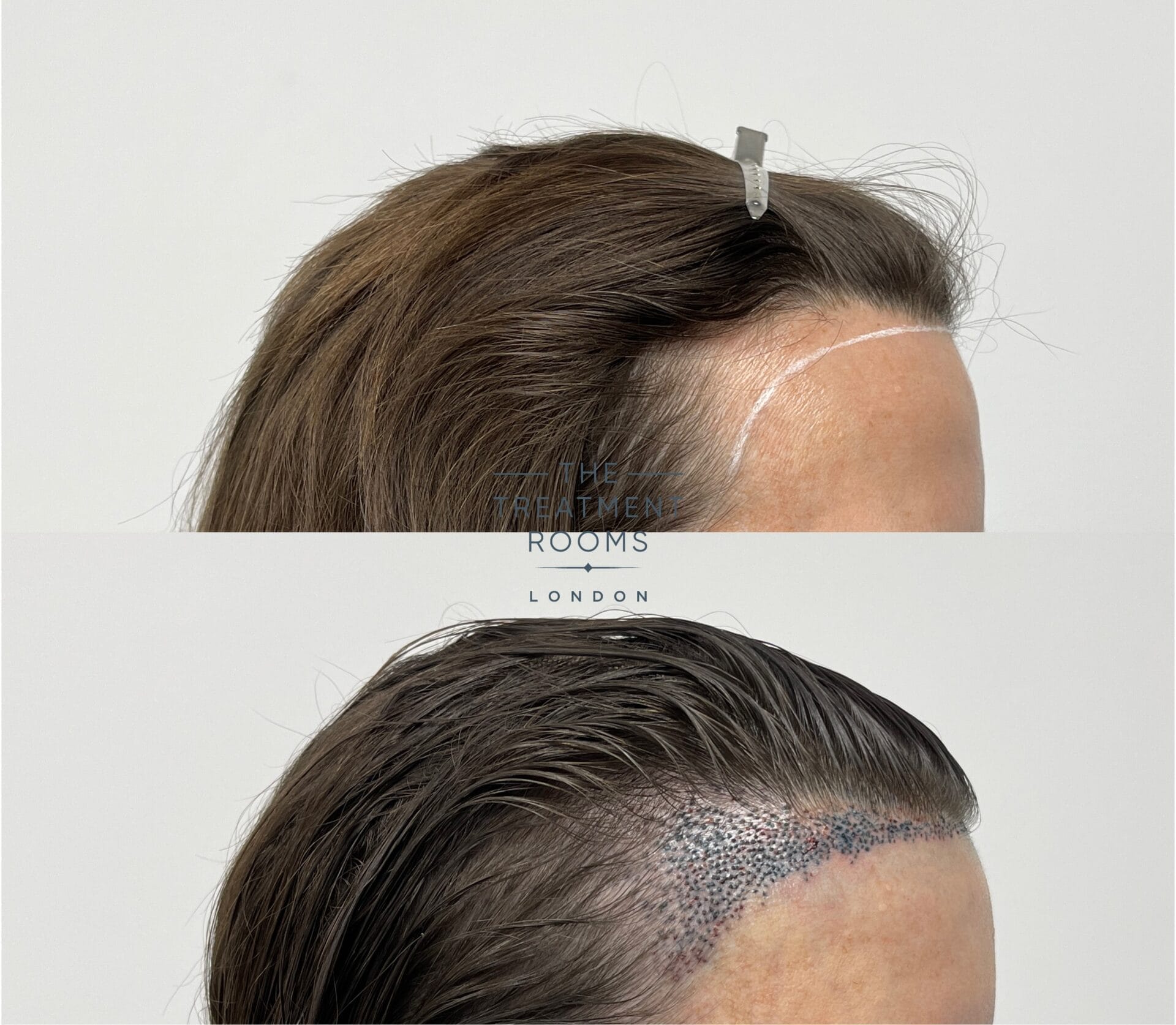 Hair Transplant UK Reviews – Real Transformations and Stories